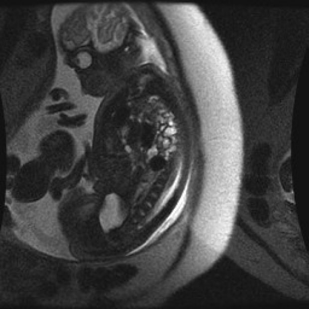 CDH Fetal MRI image